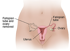 Female pelvis showing reproductive organs. Dotted lines show removal of Fallopian tube and ovary on one side.