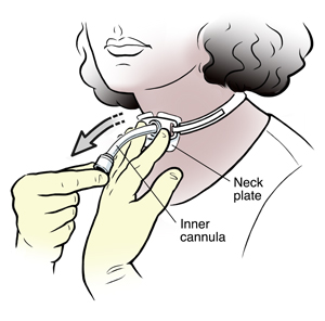 Woman removing tracheostomy tube from neck.