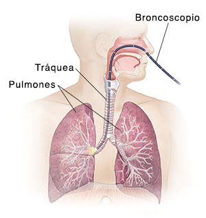 Vista frontal de la cabeza y el torso de un hombre donde puede verse el sistema respiratorio con un broncoscopio insertado por la nariz, pasando por la tráquea y hasta el bronquio derecho principal.